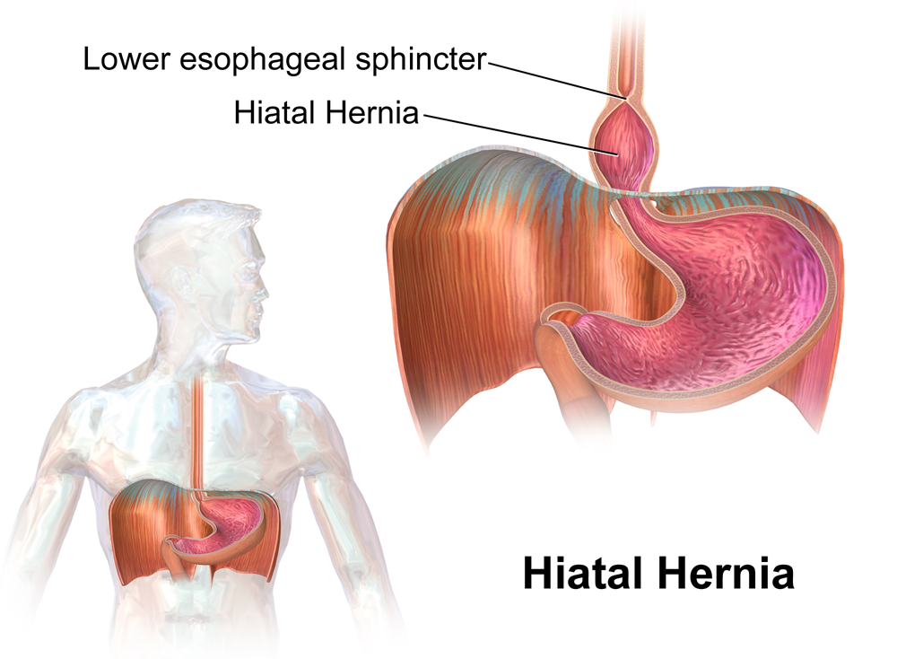 Hernia coloanei cervicale - simptome, diagnostic, tratament - Radiculite 