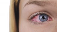 Consejos para evitar los ojos rojos