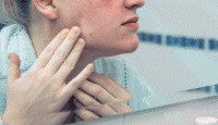 Rosácea o el falso acné que afecta a los adultos