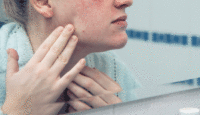 ¿Qué debe saber un adolescente para cuidar su piel?