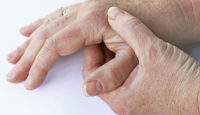 Rizartrosis o artrosis del pulgar