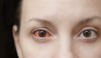 ¿Qué es la queratitis ocular?