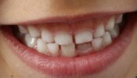 Bruxismo infantil, ¿por qué los niños aprietan los dientes?